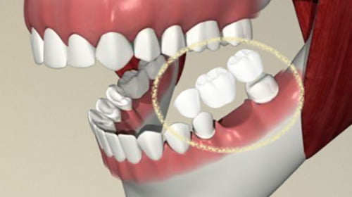 بریج دندان کودکان - دکتر حجازی