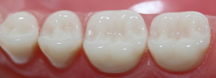 ترمیم و پر کردن دندان کودکان - دکتر حجازی