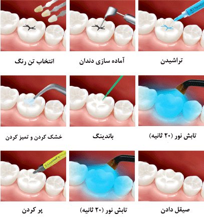 پر کردن دندان کودکان - دکتر حجازی