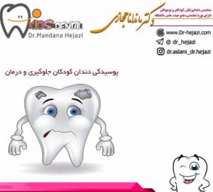 پوسیدگی دندان کودکان جلوگیری و درمان