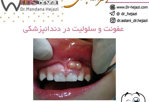 عفونت و سلولیت در دندانپزشکی