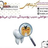 چه عواملی سبب پوسیدگی دندان می‌شوند