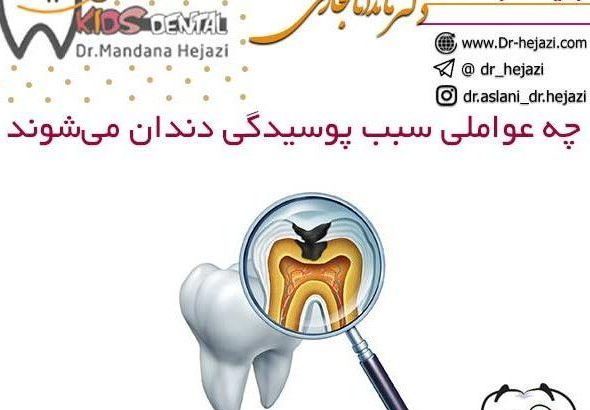 چه عواملی سبب پوسیدگی دندان می‌شوند
