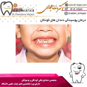 درمان پوسیدگی دندان های کودکان - دکتر حجازی