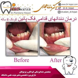 درمان دندانهای قدامی فک پایین