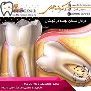 درمان دندان نهفته در کودکان