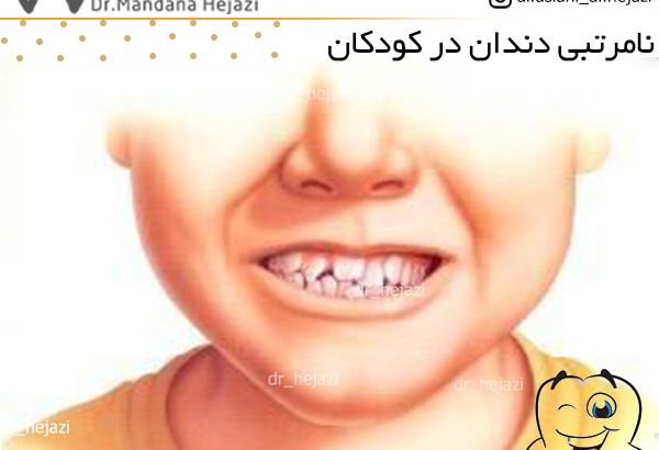 نامرتبی دندان در کودکان