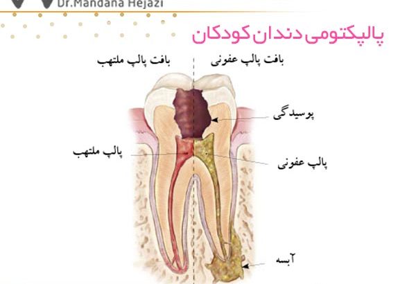 پالپکتومی دندان کودکان