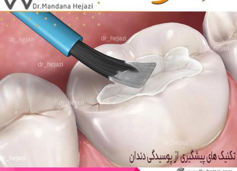 تکنیک های پیشگیری از پوسیدگی دندان - دکتر حجازی