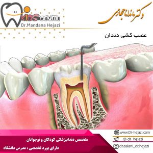 عصب کشی دندان - دکتر ماندانا حجازی